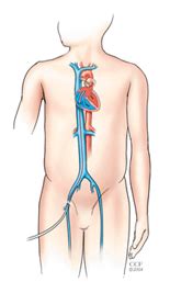 ASD Closure,ASD Closure Surgery India,India Congenital Heart Surgery