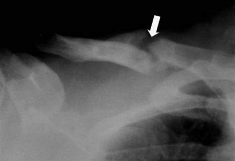 Clavicle Fracture Treatment for faster recovery | HubPages