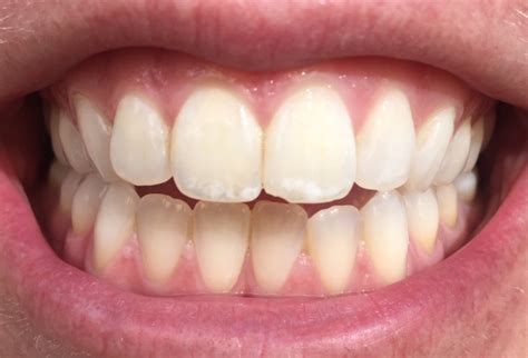 Our Guide to White Spots on Teeth | Smile Stories