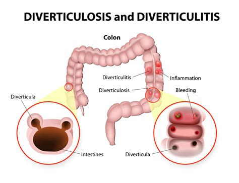 Diverticulitis - Atlanta, GA - Piedmont Colorectal Associates