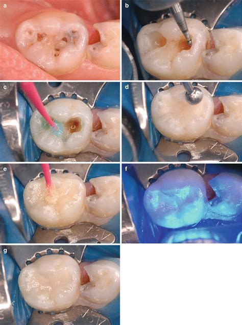 The Role of Glass-ionomers in Paediatric Dentistry | Pocket Dentistry