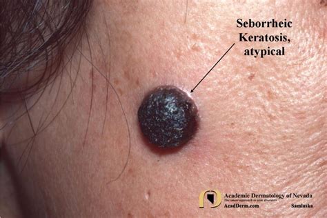 Seborrheic Keratosis: Atypical Forms... - Academic Dermatology of Nevada