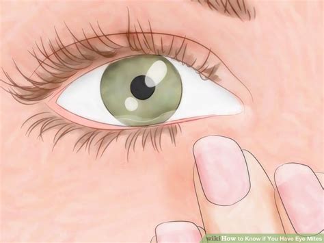 How to Know if You Have Eye Mites: 10 Steps (with Pictures) Skin ...