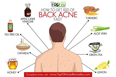 How to Get Rid of Back Acne Fast | Top 10 Home Remedies