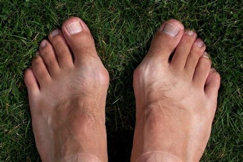 The Real Cause of Bunions, and Their Treatment | Articles | Toe Salad