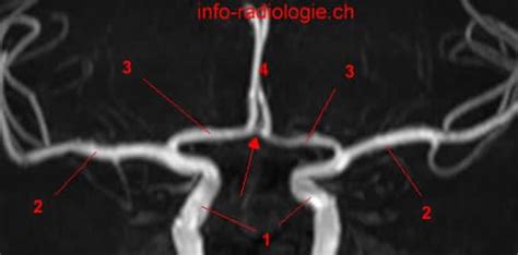 The Anatomy of the Anterior Cerebral Artery - W-Radiology