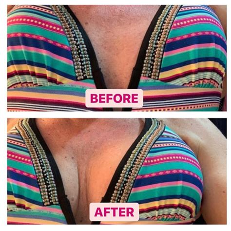 6 Fenugreek Breast Growth Before And After Picture Examples