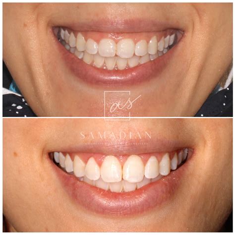 Laser Gum Contouring Before & After Photos | Samadian Cosmetic ...