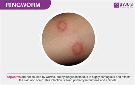 Is Ringworm Contagious During Incubation Period?