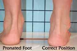 pronated foot