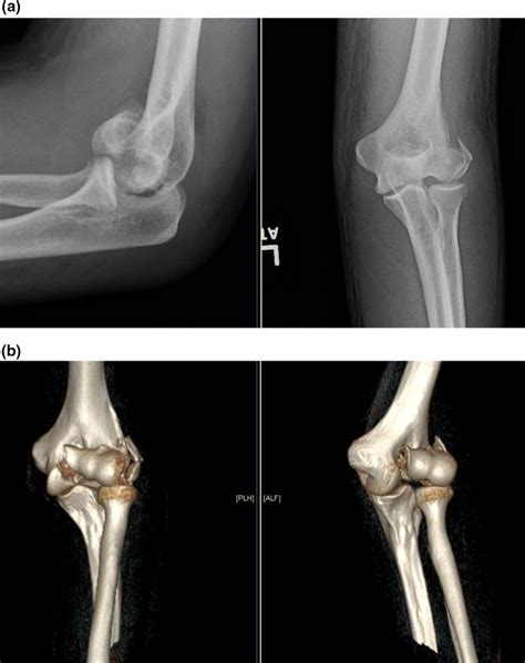 Management of distal humerus fractures | European Journal of ...