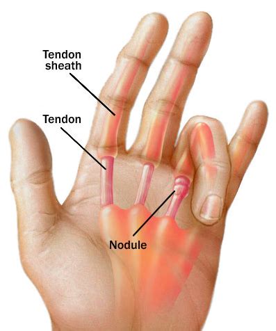 Common Causes of Finger Stiffness - The Orthopaedic Institute (2022)