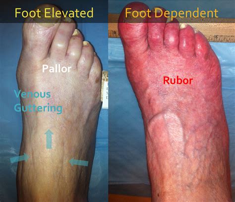 Clinical Evaluation of the Foot for Peripheral Arterial Disease ...