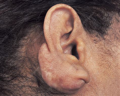 Keloid Ear