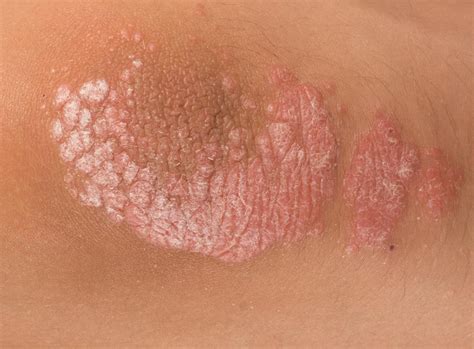 Mild Psoriasis Arms