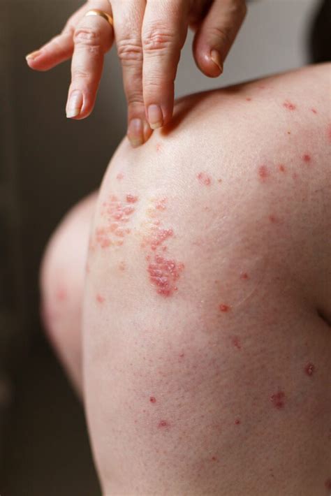 Blotchy, Red Skin? Get Solutions for Psoriasis - EVEXIAS Health Solutions