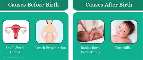 Plagiocephaly - Types, Causes, Symptoms, Complications, Diagnosis ...