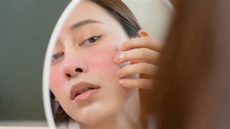 How To Treat 'Allergy Face,' According To Our Dermatologist