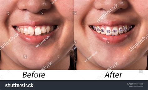 164 Dental Braces Collage Images, Stock Photos & Vectors | Shutterstock