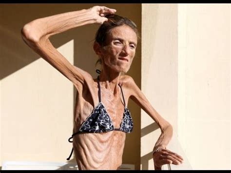 Skinniest Person In The World- 55 lbs - YouTube