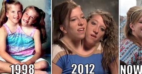 Fascinating Facts About Famous Conjoined Twins Abby And (25 min ...