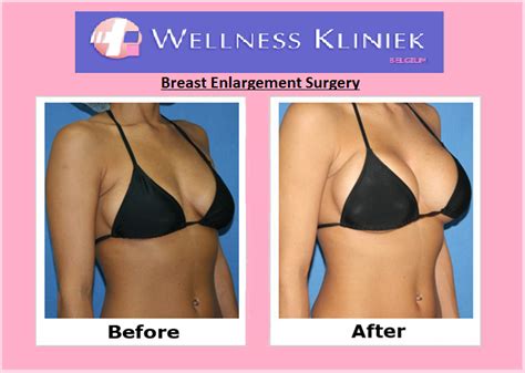 Breast Implants | Implants breast, Breast enlargement, Breast surgery