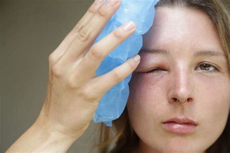 Swollen Eyelids: Causes & Treatment | MyVision.org