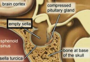 Sella Turcica - Bone, Function, Site, Location, Anatomy, Empty Sella