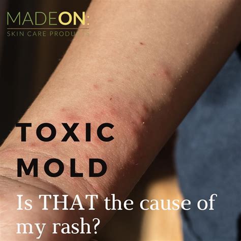 Symptoms of Toxic Mold Exposure - MadeOn Skin Care