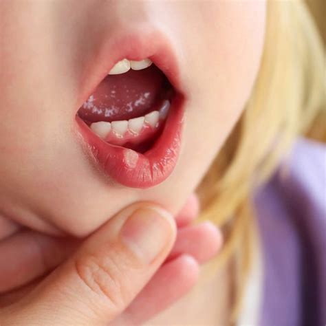 6 Remedies to Combat Cold Sores in Children - Step To Health