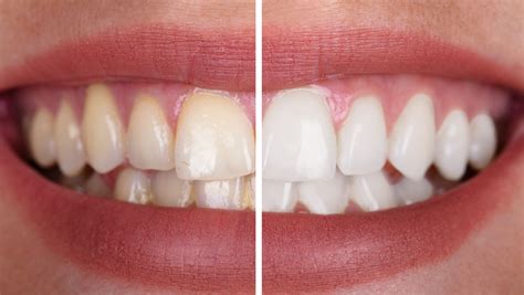 Deep Teeth Cleaning: Before and After - Dental Health Society