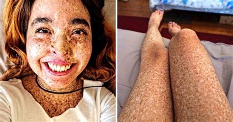 Covered in thousands of freckles, Andrea Ivonne Monroy, 26, has ...