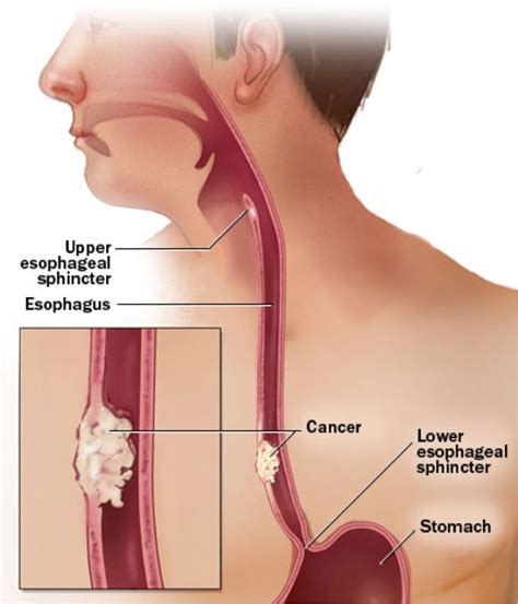 Esophageal Spasm Causes, Symptoms, Treatments, and More