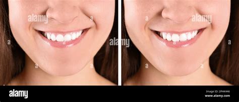 Young woman before and after gingivoplasty procedure, closeup. Banner ...