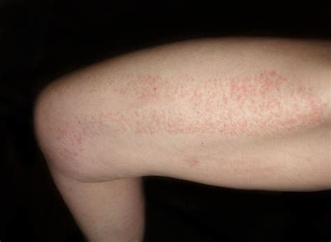 Red Spots on Skin: Causes, Diagnosis, and Treatments