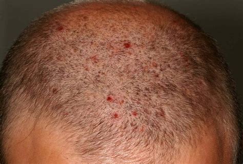 Scalp Pimples: Causes and What Naturally Helps