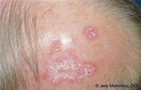 Discoid Lupus Erythematosus