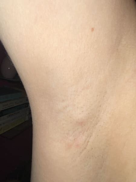 What Are The Little Lumps In My Armpit Store | cdlguaiba.com.br