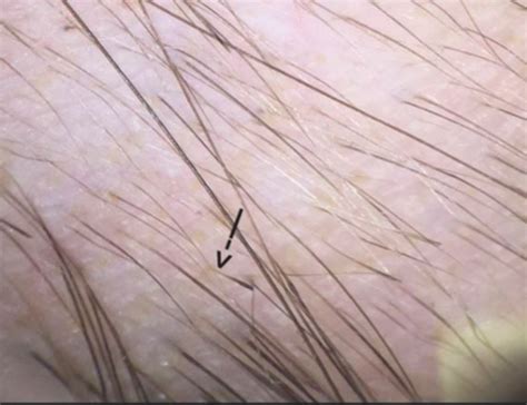 ALOPECIA AREATA: Signs of Regrowth — Donovan Hair Clinic