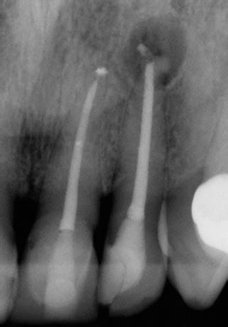 Maxillary Left Central Incisor (UL1) Root Canal Treatment, Maxillary ...