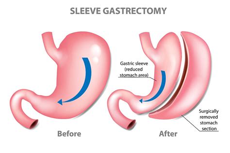 The honest truth about gastric sleeve surgery