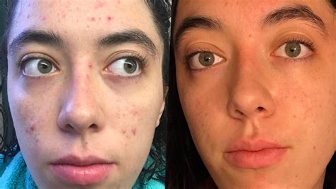 Tretinoin Before After, Before and after month 2 on 05% tretinoin cream ...