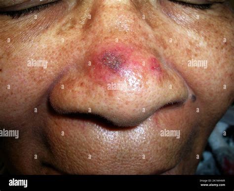 Discoid lupus erythematosus Stock Photo - Alamy