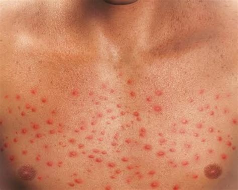 Liver Disease Itchy Skin Rash