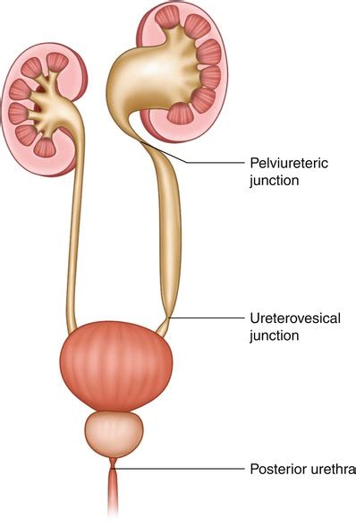 PUJ Obstruction : What Is It, Symptoms, Diagnosis and Treatment |Dr. Ali