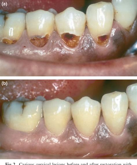 Figure 2 from Glass-ionomer cement restorative materials: a sticky ...