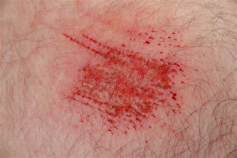 Abrasion Wound in Caucasian Skin Close Up Stock Photo - Image of ...