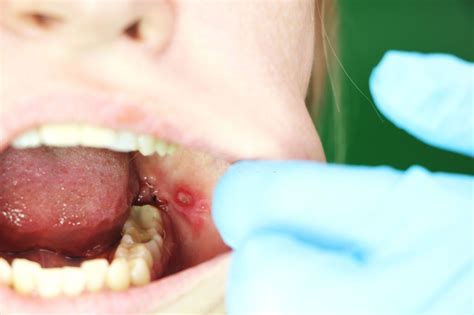 Mouth Larva or Oral Myiasis: Causes, Symptoms & Treatment