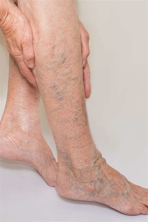 10 home remedies for varicose veins