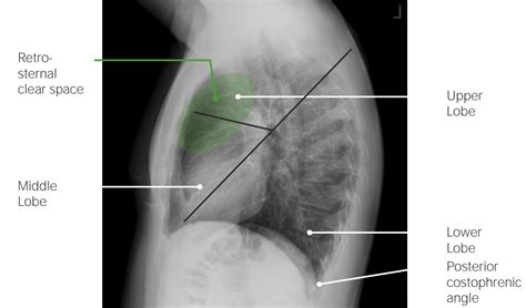 Pulmonary Radiology | Concise Medical Knowledge